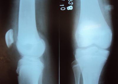 ACL Bony Avulsion fixed with Pull Through Technique