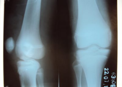 ACL Bony Avulsion fixed with Pull Through Technique