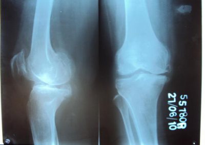 Primary_oteoarthritis_knee
