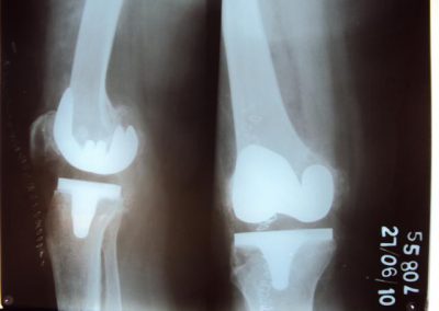 Total_knee_replacement